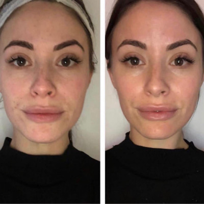 dermal fillers injection in woman's face